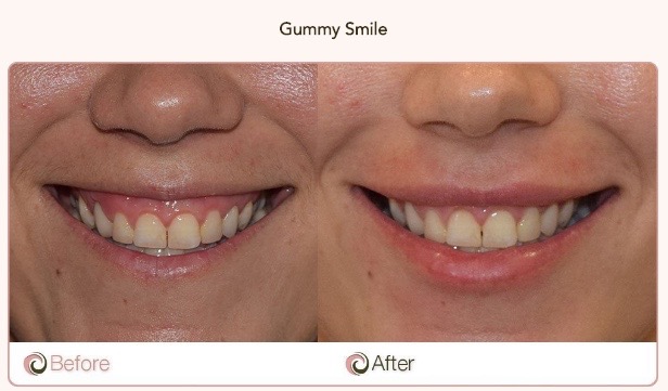 Esthetic Botox