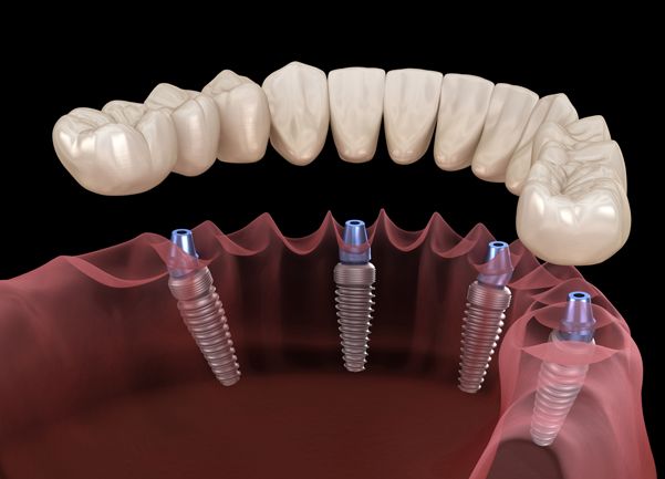 All-On-4 - Smile Dental