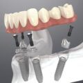 Smile Dental Care | Dentist in Scotts Valley and Santa Cruz – Cosmetic