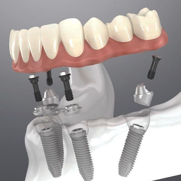 All On 4 - Smile Dental Care